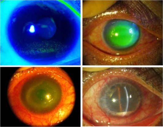 ccos角膜丨陈百华教授术后角膜病变的共焦显微镜特点与治疗策略