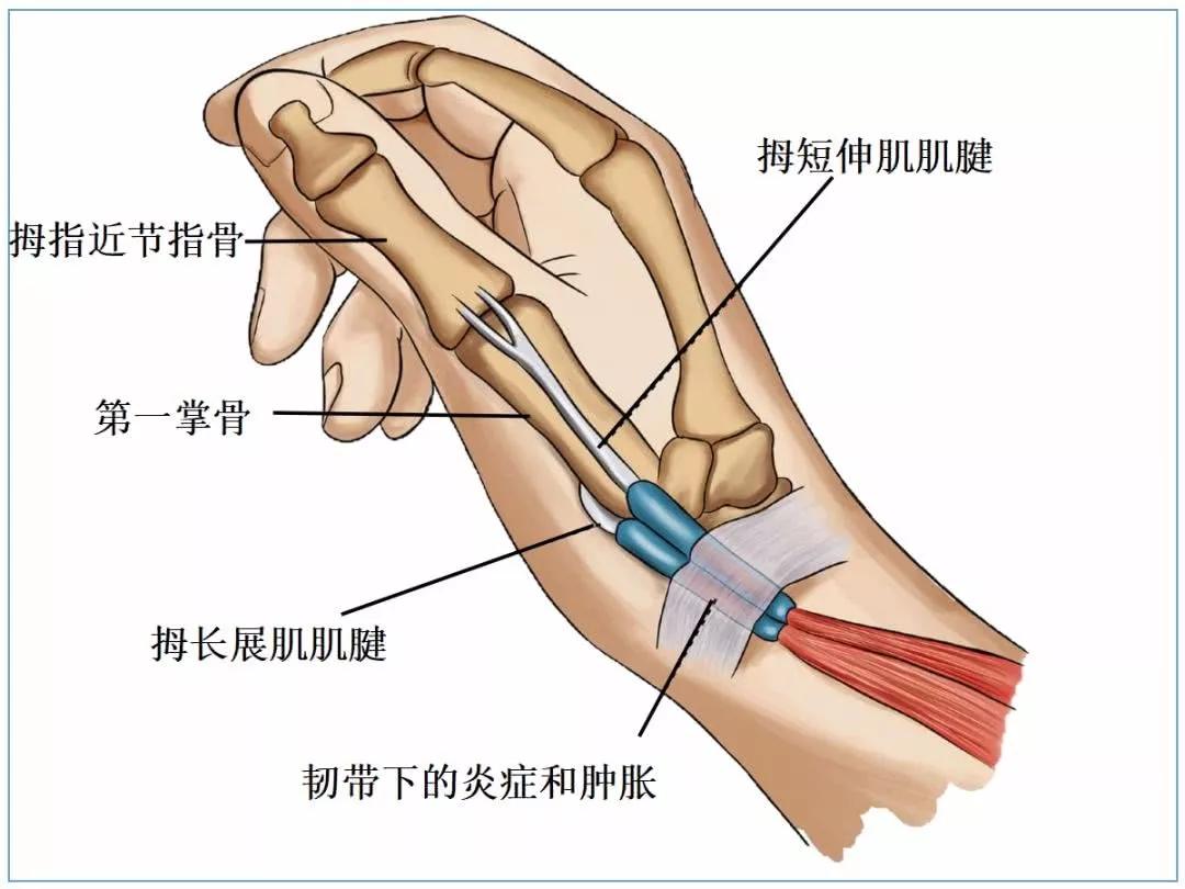 手腕腱鞘炎位置图片图片