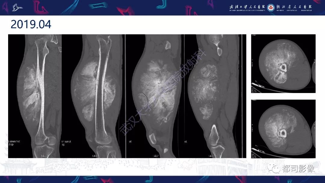 骨旁骨肉瘤影像诊断