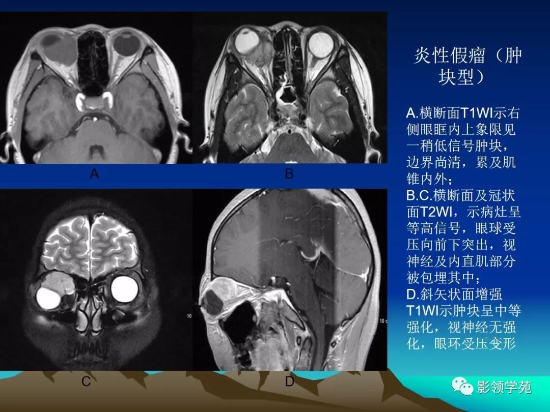 分別為眼眶橫斷面脂肪抑制t1wi和t2wi,示兩眼球突出,兩側多條眼外肌增