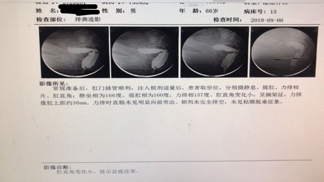 正常排粪造影图片图片