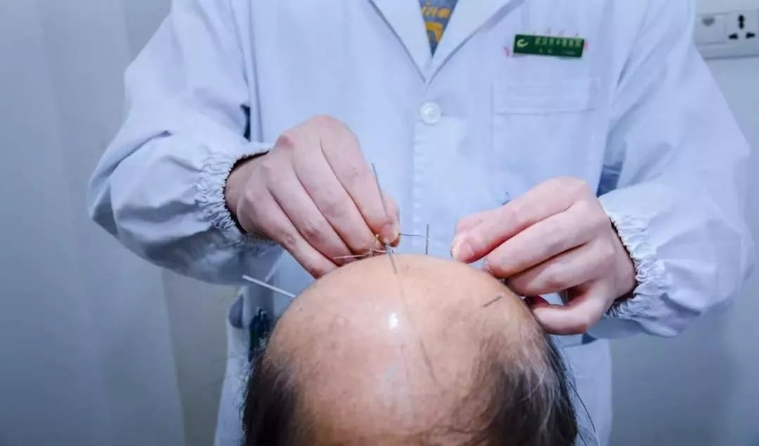 腰腿痛,偏头痛,关节炎,失眠,落枕等等,针灸的治疗方法是很不错的,但是