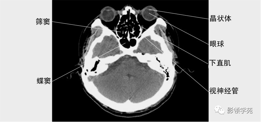 视神经管ct扫描范围图片