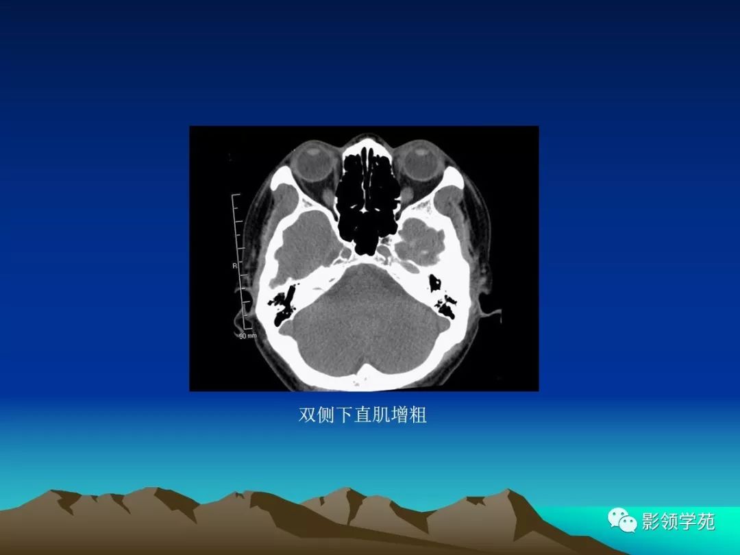 眼和眼眶的影像學診斷