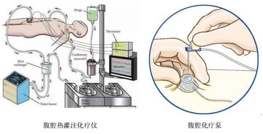 化疗泵使用图片示意图图片