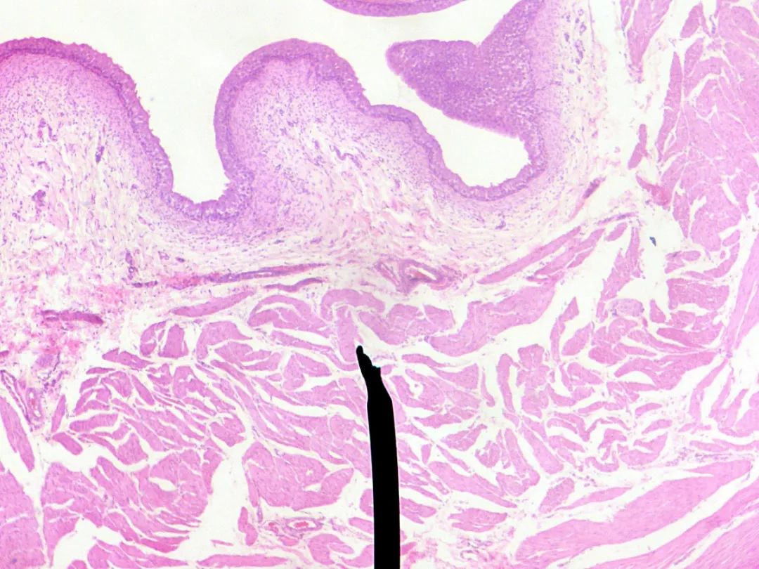膀胱会不会被尿憋破?