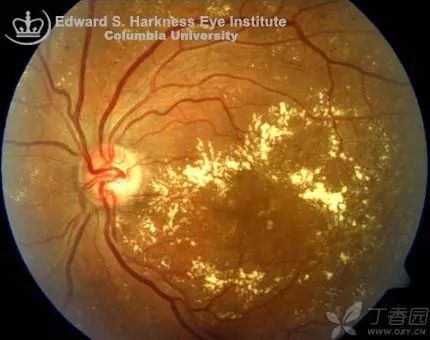 软性渗出:无特殊形态的棉絮状白色斑片,并非真正的渗出,而是微动脉