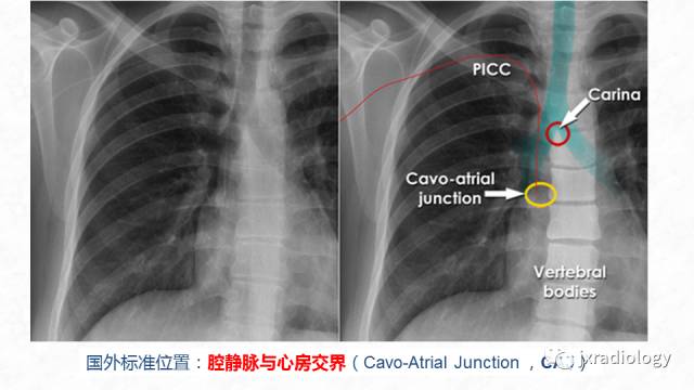 picc尖端的胸片定位