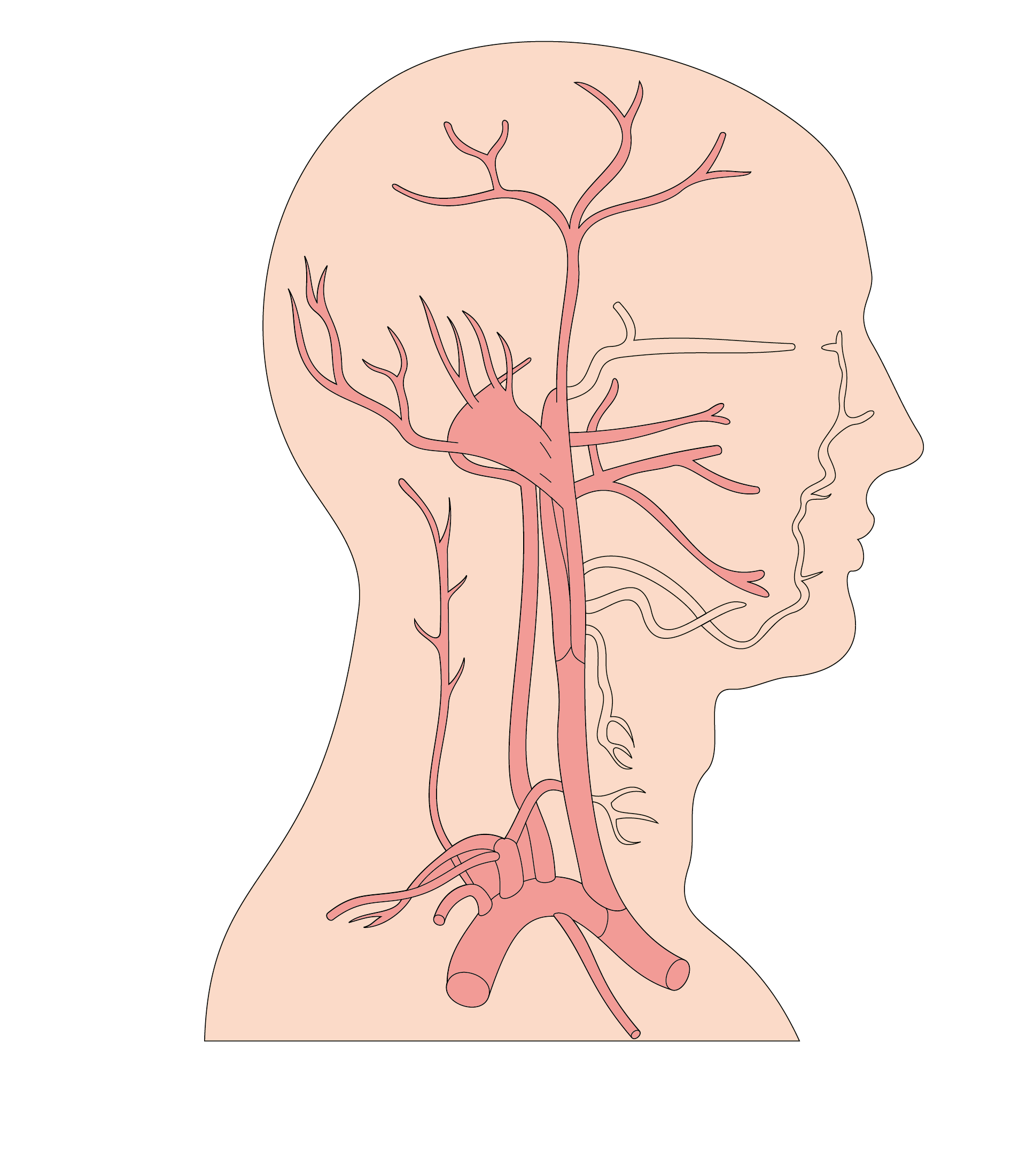 無症狀腦梗塞很危險醫生說平均5個老年人就有一個得這種病