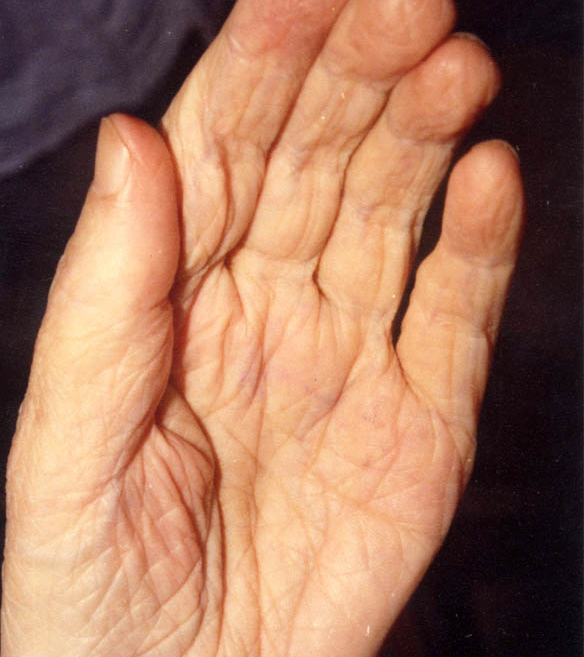 北京德胜门中医院疼痛科:通过哪些症状可以判断是肌肉萎缩?