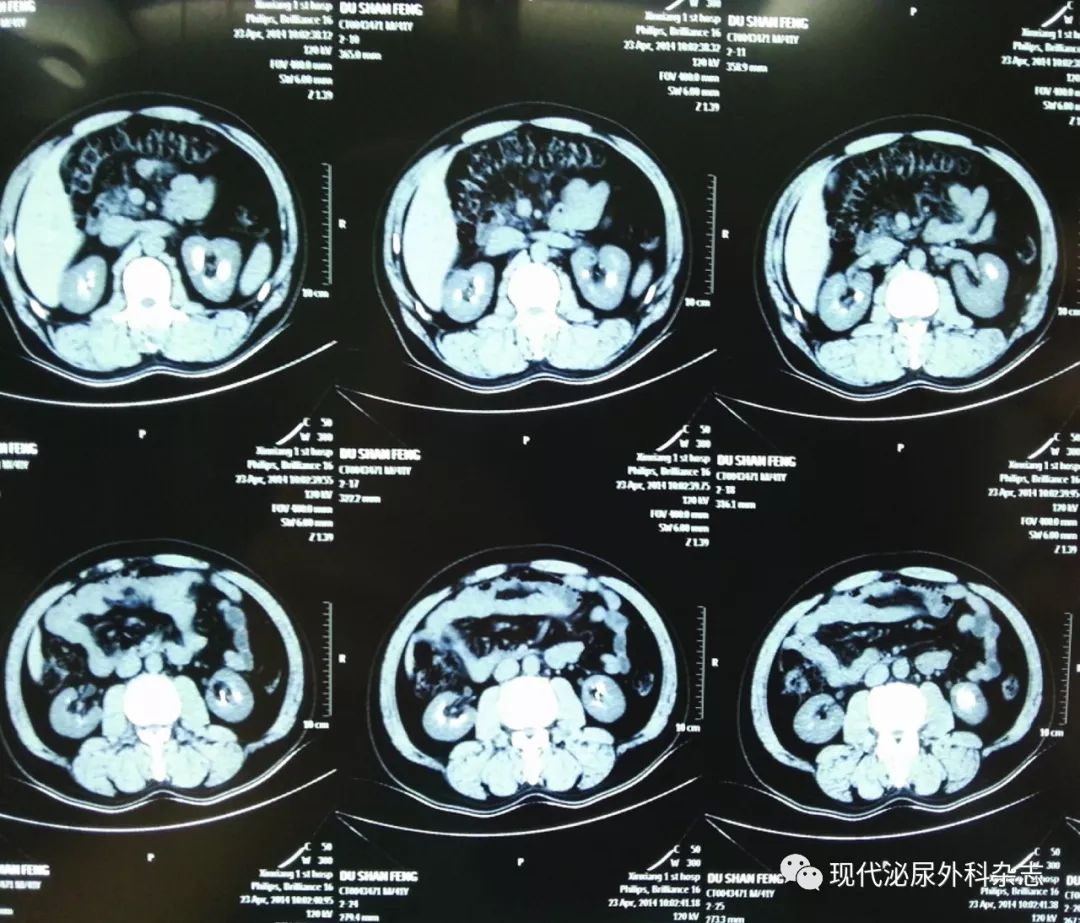 海绵肾声像图图片