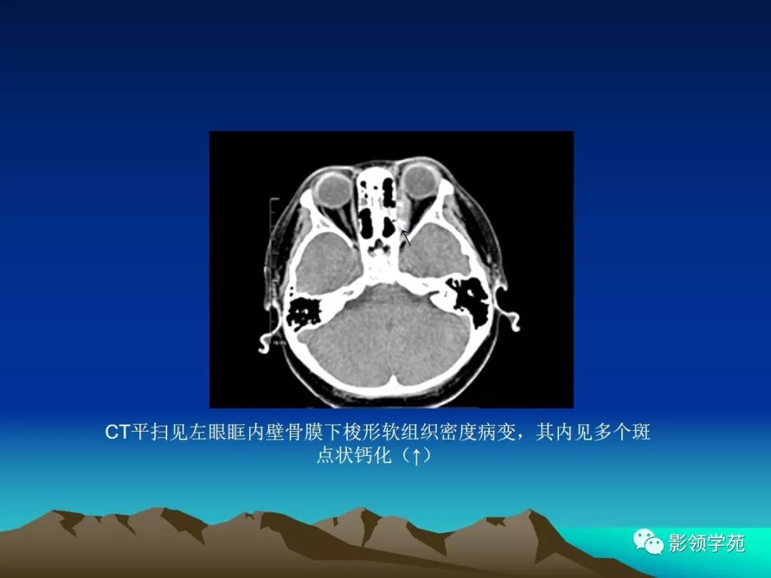 分別為眼眶橫斷面脂肪抑制t1wi和t2wi,示兩眼球突出,兩側多條眼外肌增