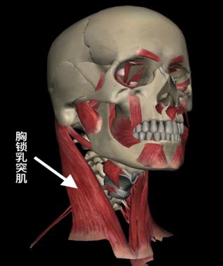 是由於一側胸鎖乳突肌纖維攣縮從而導致頭和頸的不對稱畸形,頭傾向患