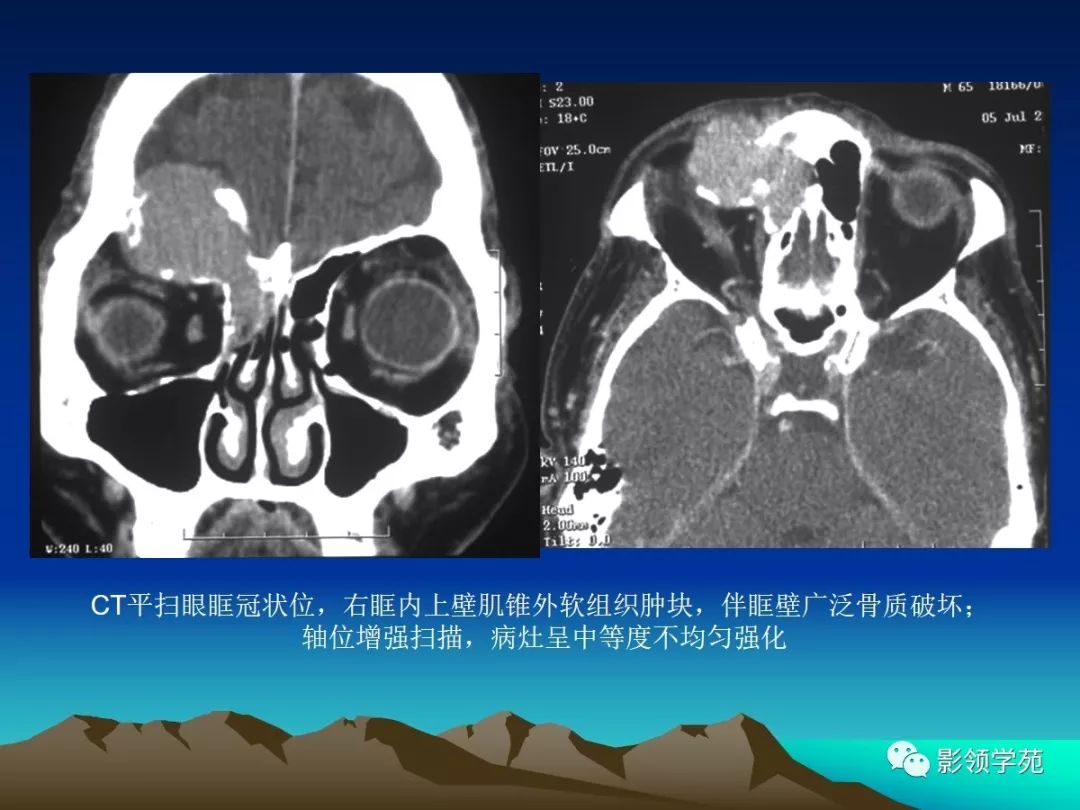 眼和眼眶的影像学诊断