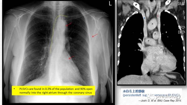 picc尖端的胸片定位