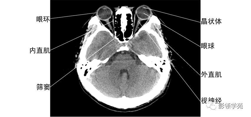 ct影像眼的附属结构:由眼外肌,视神经,泪器以及眶内的脂肪,血管,神经