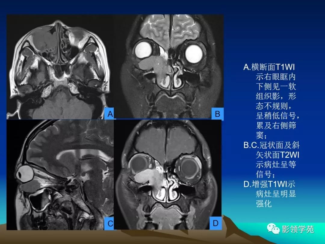眼和眼眶的影像学诊断