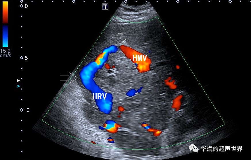 超声肝脏工字征图解图片