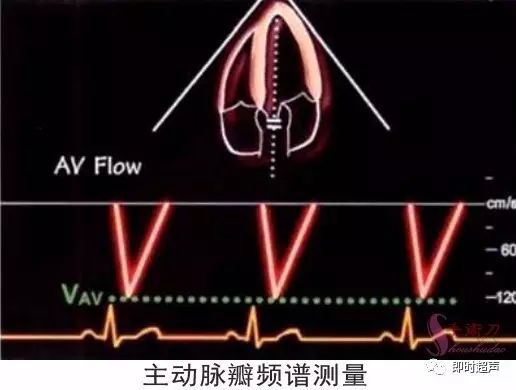 图解二维超声心动图正常值与测量_mm