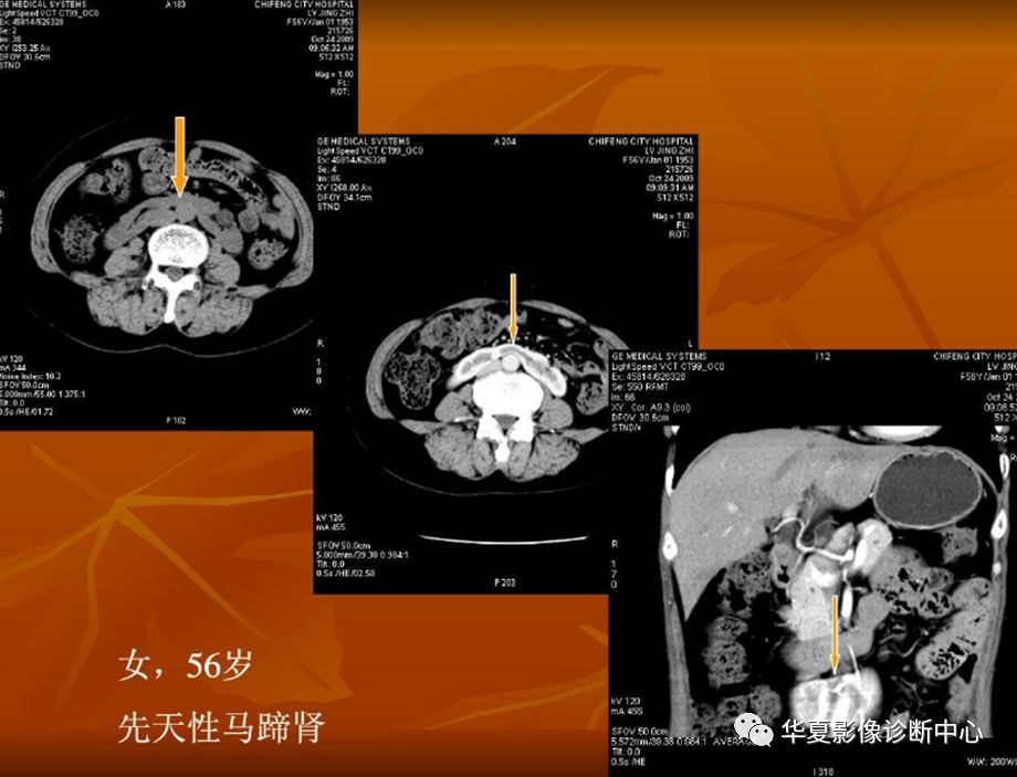 泌尿系統發育異常的影像識別