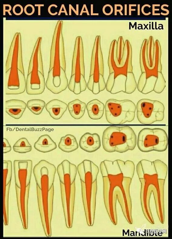 儿童乳牙开髓深度图片