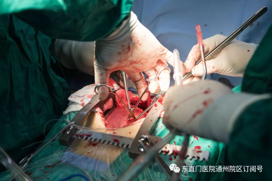 心脏手术开刀位置图片图片