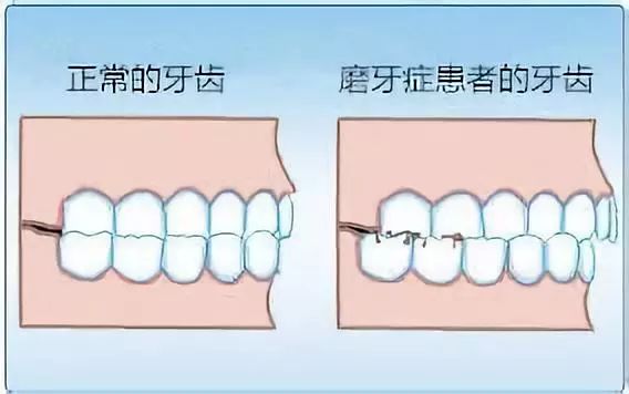 成人晚上磨牙是什么造成的这3个方面该查查了