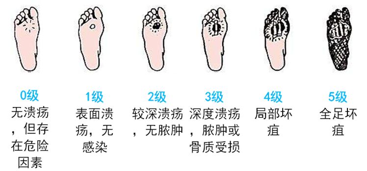 【护健图文】脚部出现这些变化注意了,警惕是糖尿病足