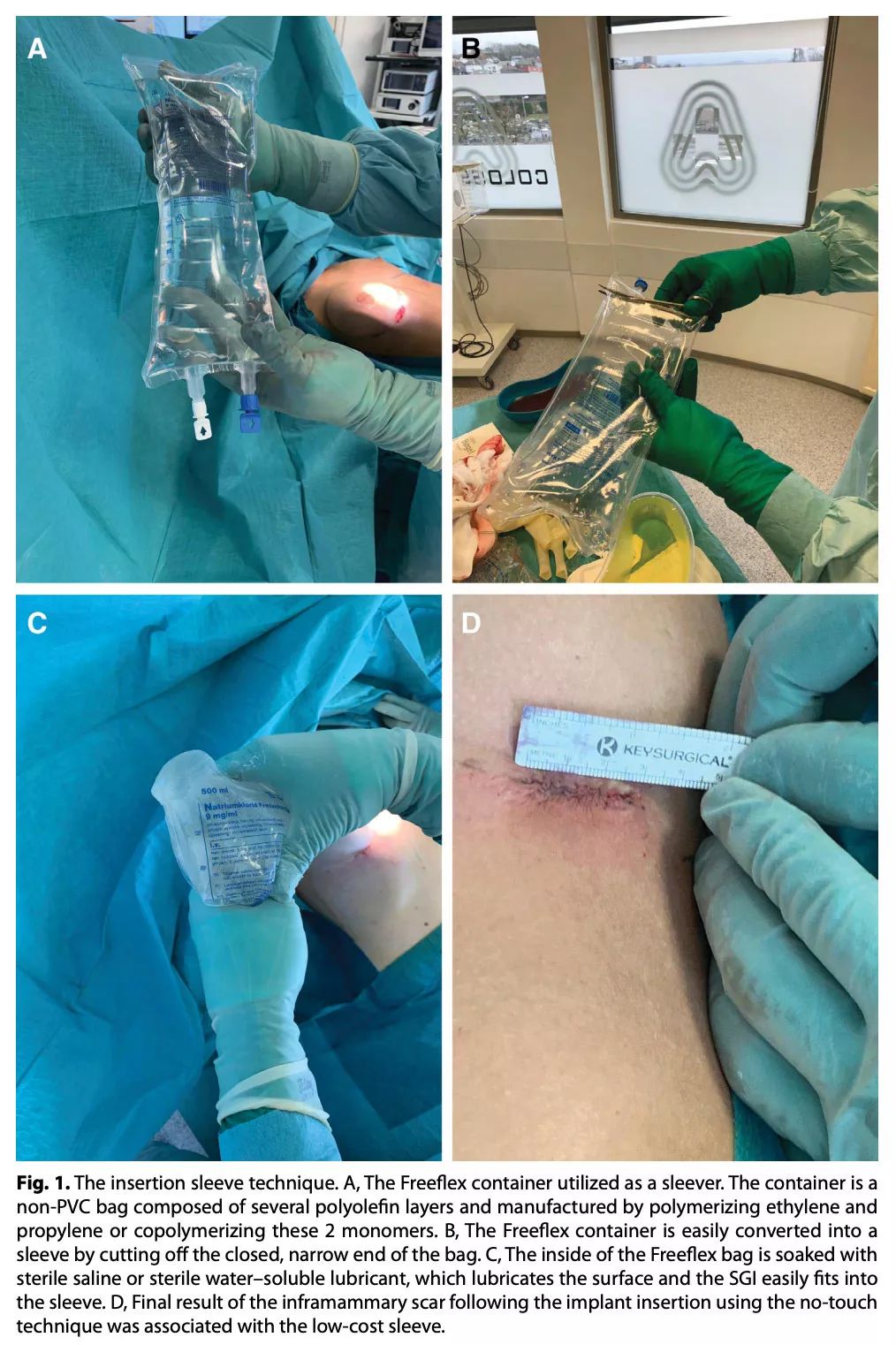 医用盐水袋,用作"袖套",辅助置入硅胶乳房假体:简易,低成本,有效减少