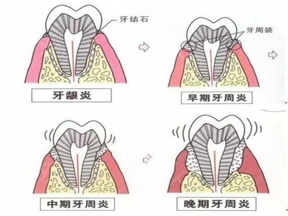 牙槽骨功能丧失,牙齿脱落牙槽骨吸收,牙齿开始松动牙周袋,引发口臭