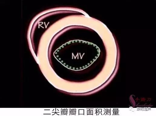 图解二维超声心动图正常值与测量_mm