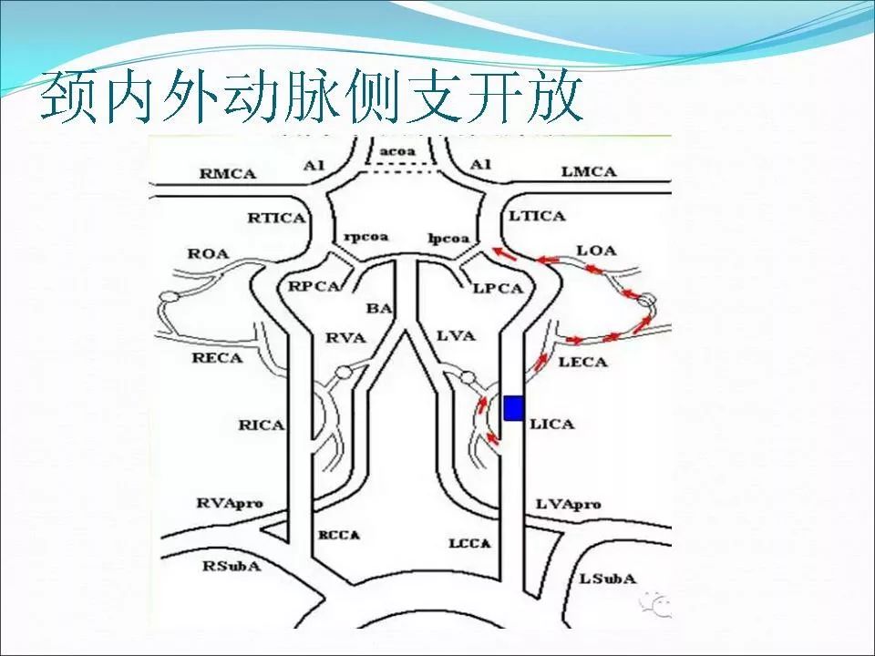 脑侧支循环影像评估及临床意义