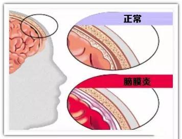 因父母错把脑膜炎当成感冒,孩子严重脑损伤,该如何区分呢?