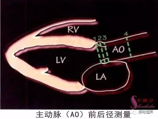 主动脉与室间隔结合点位于图的中线上,测量图解:左室后壁(lvpw)厚度