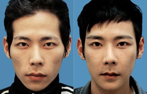 男生整容要避免女性化!_男人