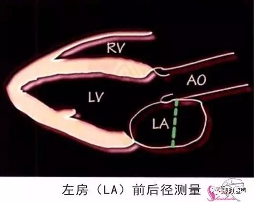 圖解二維超聲心動圖正常值與測量