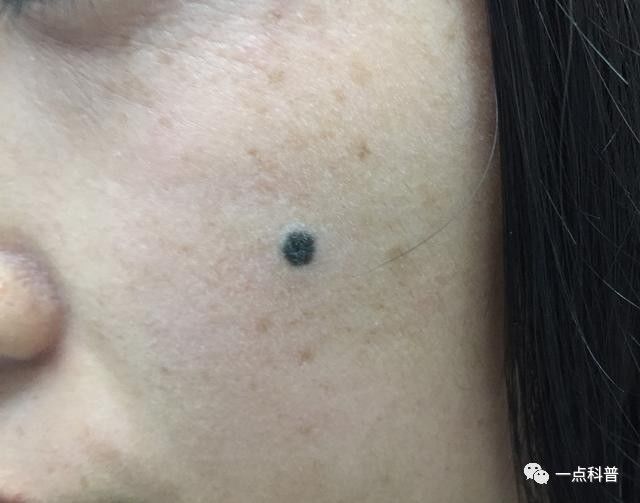 人生生下来没有痣,为什么长大后就冒痦子呢?_问题