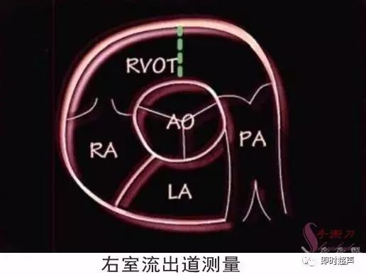 图解二维超声心动图正常值与测量_mm