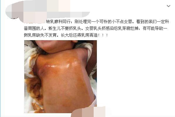 原创1岁女童胸口红肿医生别用这种陋习带娃会让娃得败血症