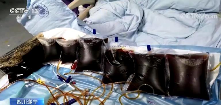 全身血液被置换7.5次!女子不慎被马蜂蜇 置换血浆3万毫升
