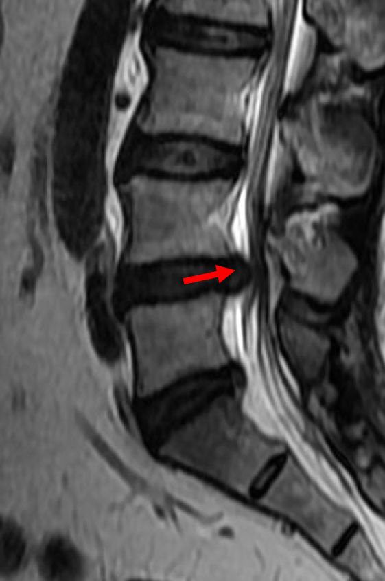 「脊柱mri進階指南」課程椎體內突出:突入椎體內形成許莫氏結節前方