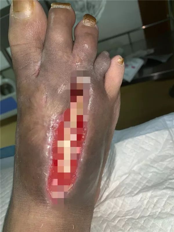 一颗钉子引发截肢危险竟然是它惹的祸