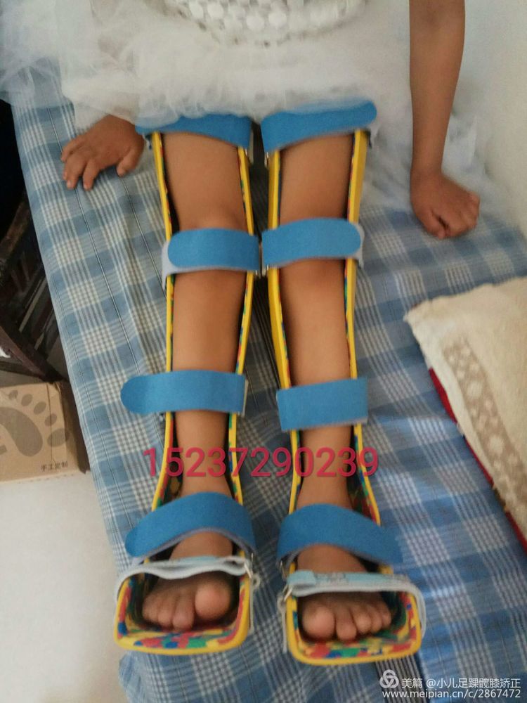 河南安阳小儿矫形康复中心矫正儿童o型腿和x型腿效果杠杠滴不吃药不