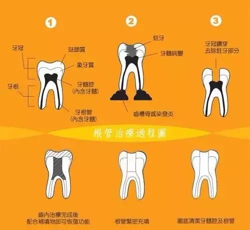根管治疗后牙齿已经不疼了,为什么还要戴牙冠呢?