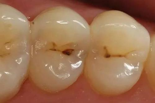 龋病引发蝴蝶效应如何防治