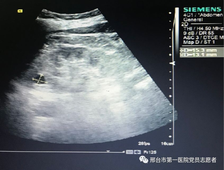 泌尿系彩超你了解么?