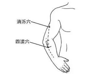 偏头痛 此类病人四渎穴常有压敏反应