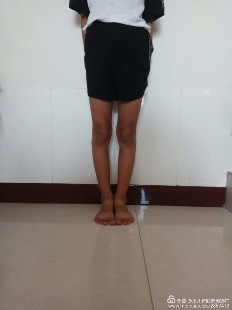 河南安阳小儿矫形康复中心矫正儿童o型腿和x型腿效果杠杠滴不吃药不