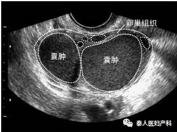 不可言喻的痛子宮內膜異位性疾病