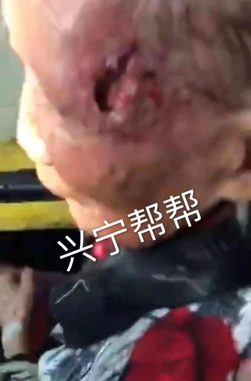 画面恶心慎入!黄塘医院一位90多岁阿婆左眼边长虫,从里面造了个洞